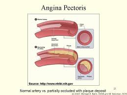 angina pectoris