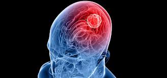 nádor na mozku